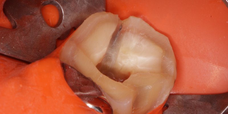 치료 중 확대해서 본 어금니. 치아 가운데를 위아래로 가로지르는 어두운 선이 금입니다.
