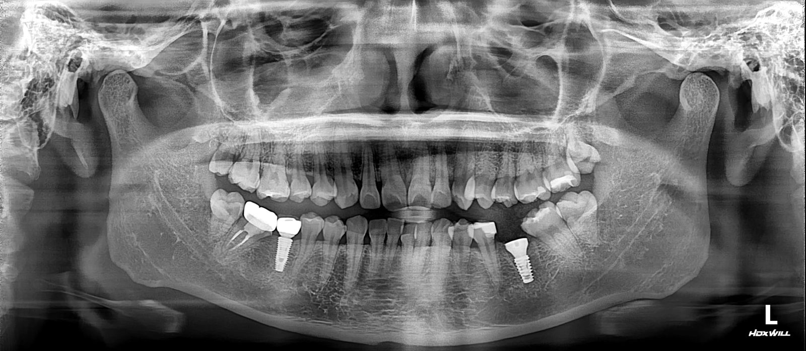 파노라마 X-ray. 위아래 치아와 턱뼈 전체가 한 장의 평면 사진으로 보이며, 아래턱 양쪽에 임플란트가 하나씩 있습니다.