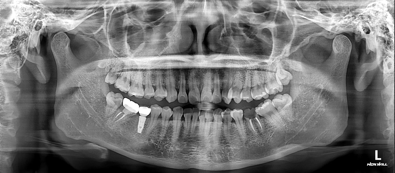 한 사람의 파노라마 X-ray. 사진 왼쪽 아래 어금니 자리에 임플란트가 있고, 사진 오른쪽 아래 어금니들에는 신경치료로 채운 뿌리가 하얗게 보입니다.