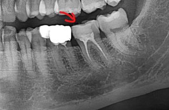 신경치료를 마친 아래 어금니의 X-ray. 빨간 화살표가 가리키는 치아는 뿌리 안이 하얗게 채워져 있지만 크라운은 씌워져 있지 않습니다.